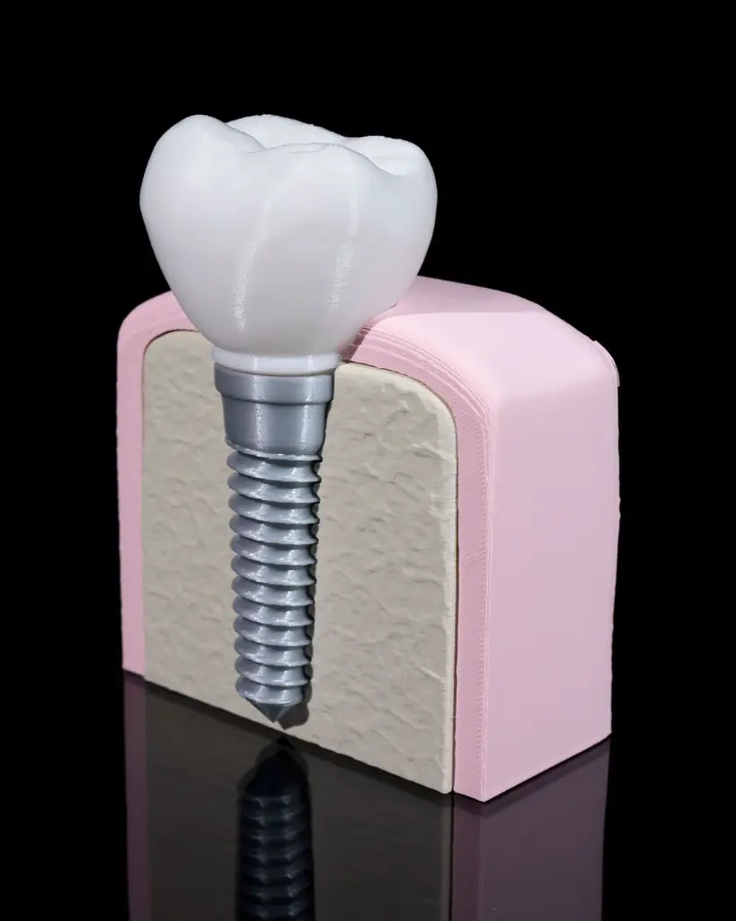 Dental_Implant_8_b1e3e91e24.webp