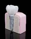 Dental_Implant_8_b1e3e91e24.webp