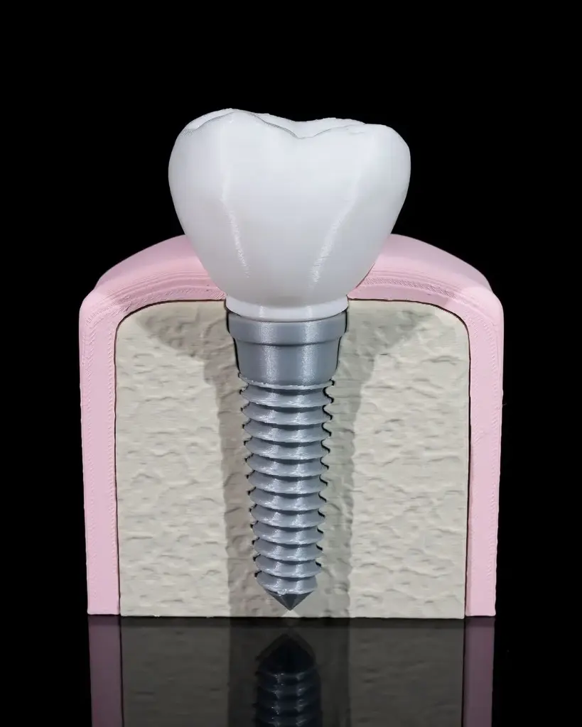 Dental Implant Model