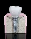 Dental Implant Model