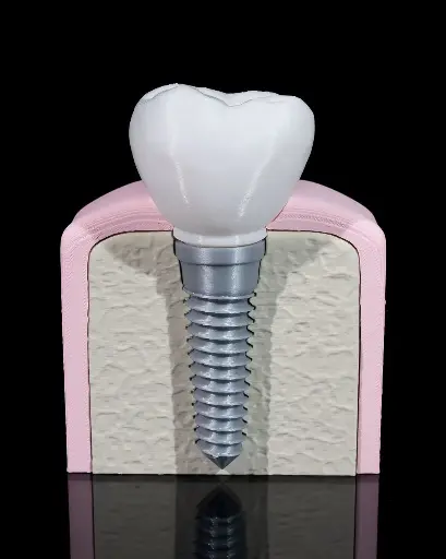 Dental Implant Model